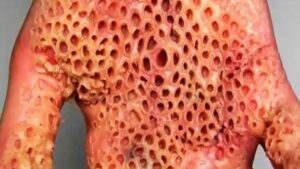 La tripofobia es la aversión o miedo a patrones irregulares de pequeños agujeros o protuberancia